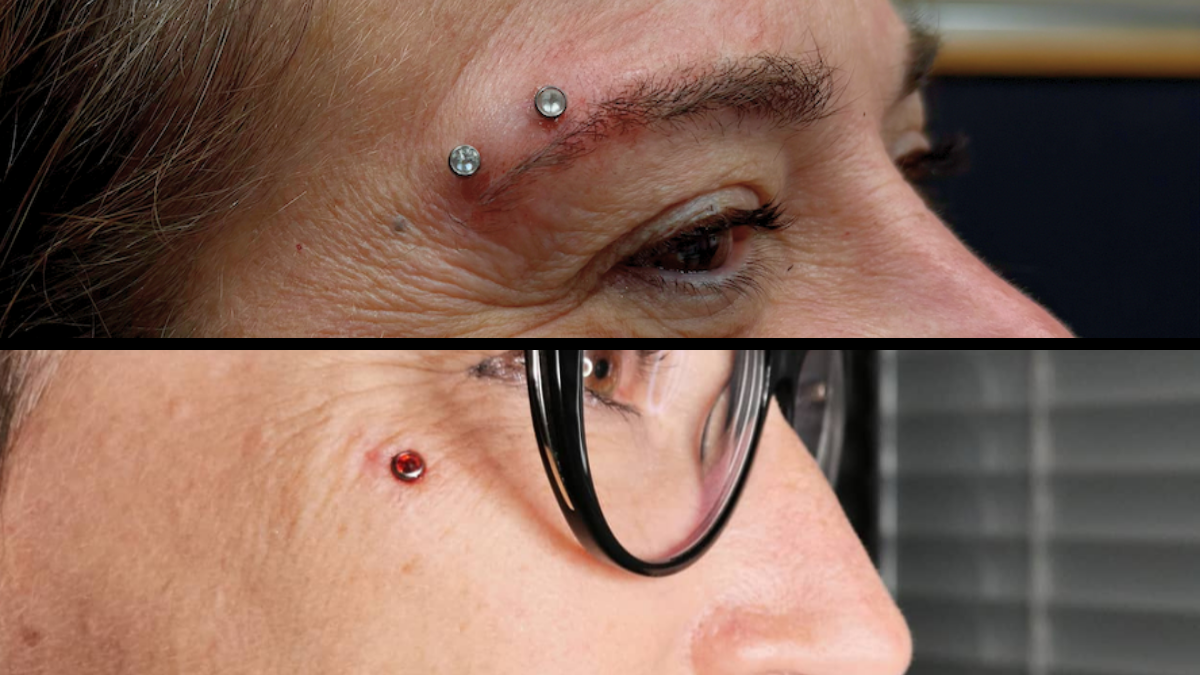 A dermal anchor and a healed surface piercing