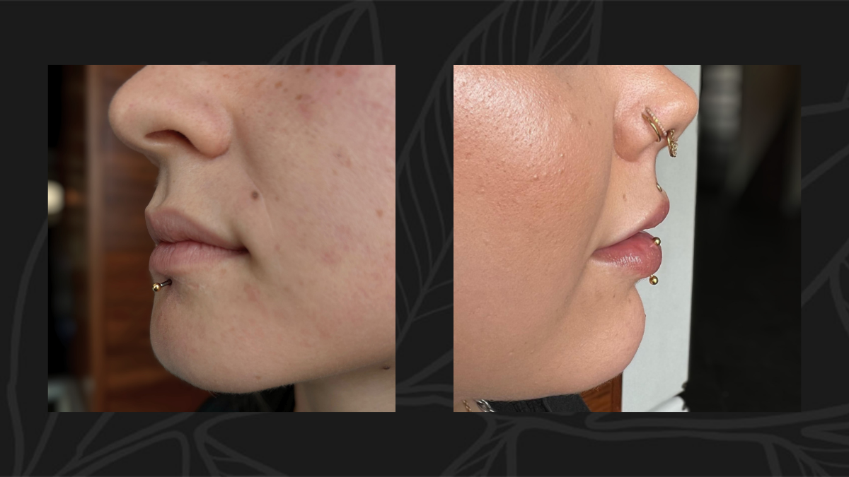 A healed labret piercing below the lower lip and a vertical labret going up, through the bottom lip 